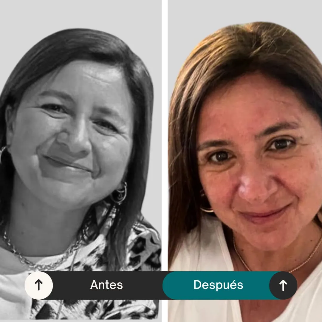 imgi_23_antes-despues-blefaroplastia-cor