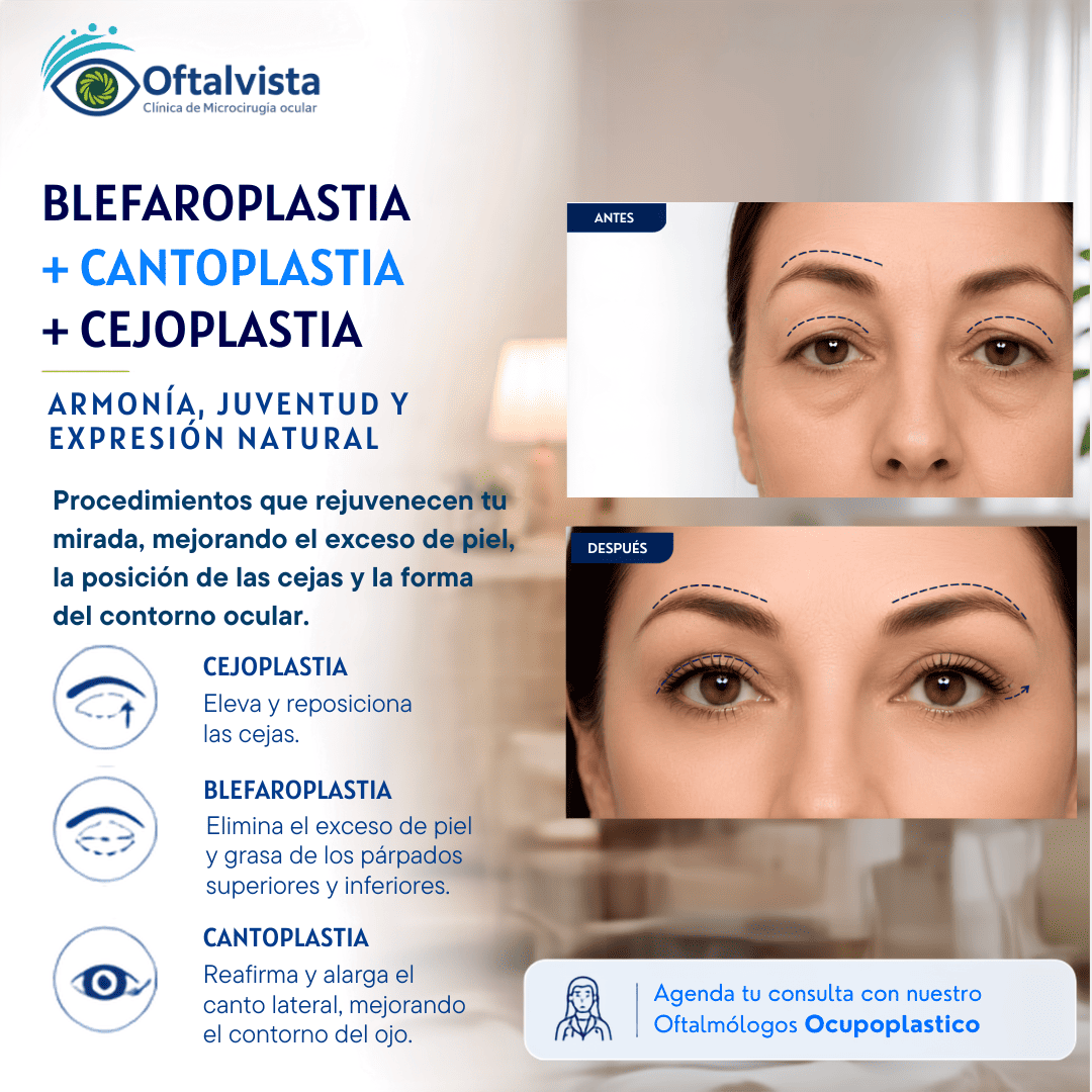 prom-agosto-mobile-Beflaroplastia